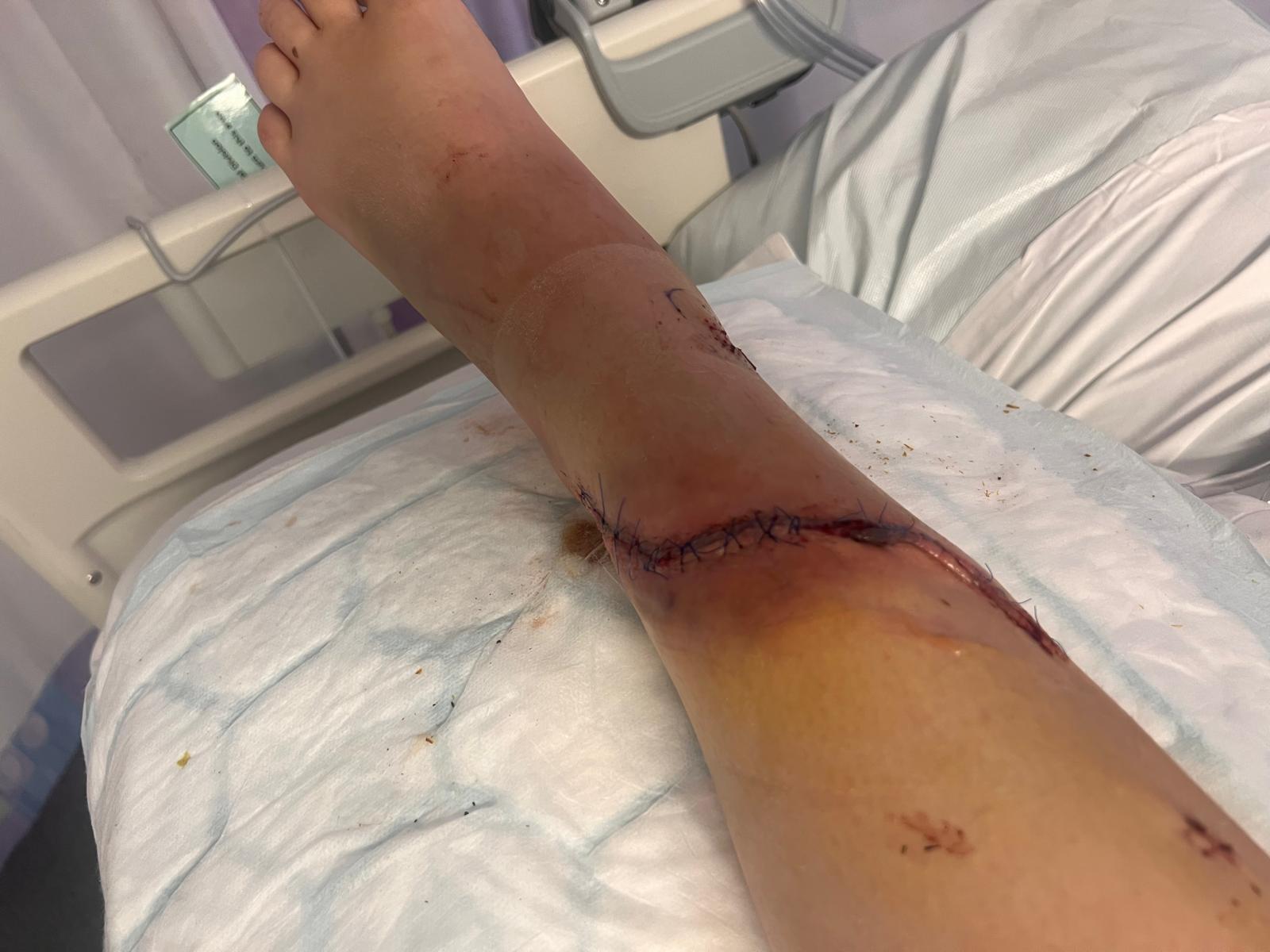Sutured surgical wound on the lower leg during early healing