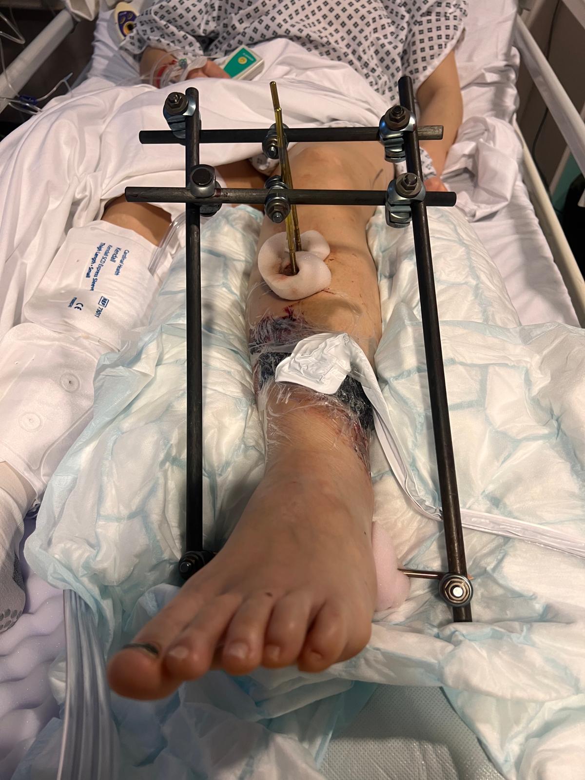Lower leg stabilised in an external fixation frame in hospital