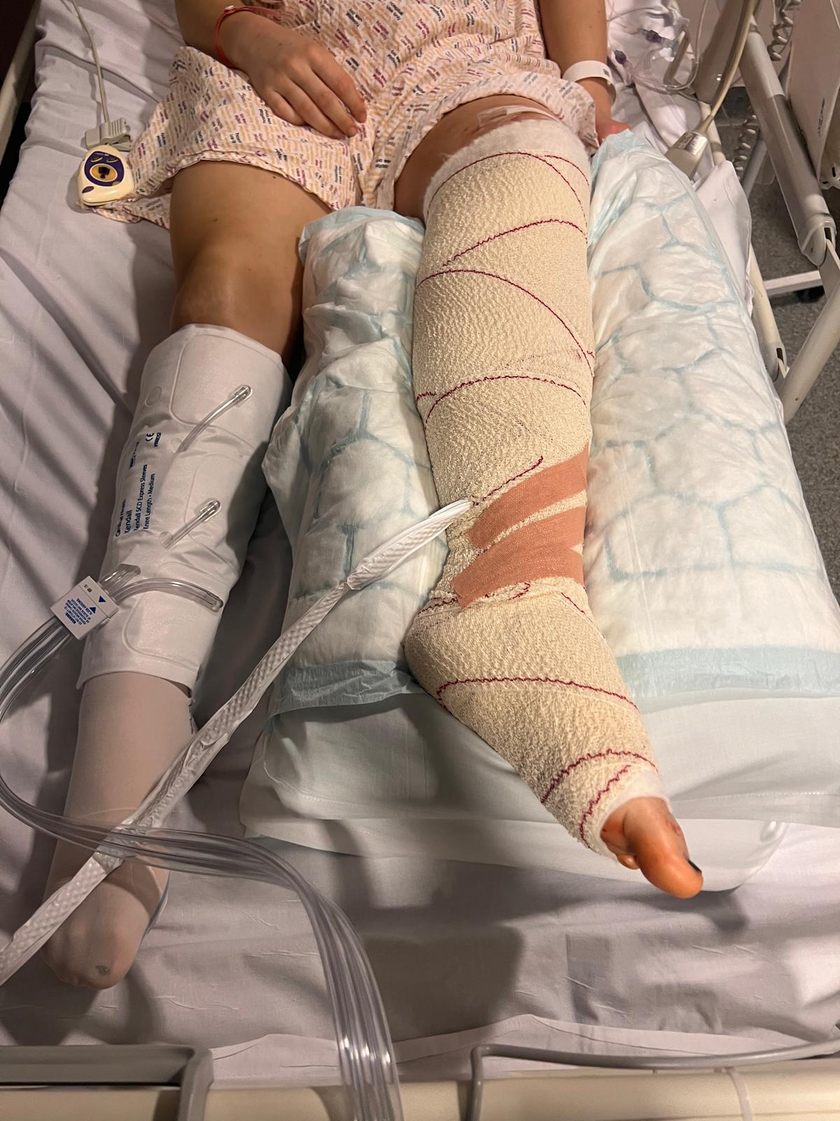 Lower leg dressed and bandaged after surgery in a hospital bed
