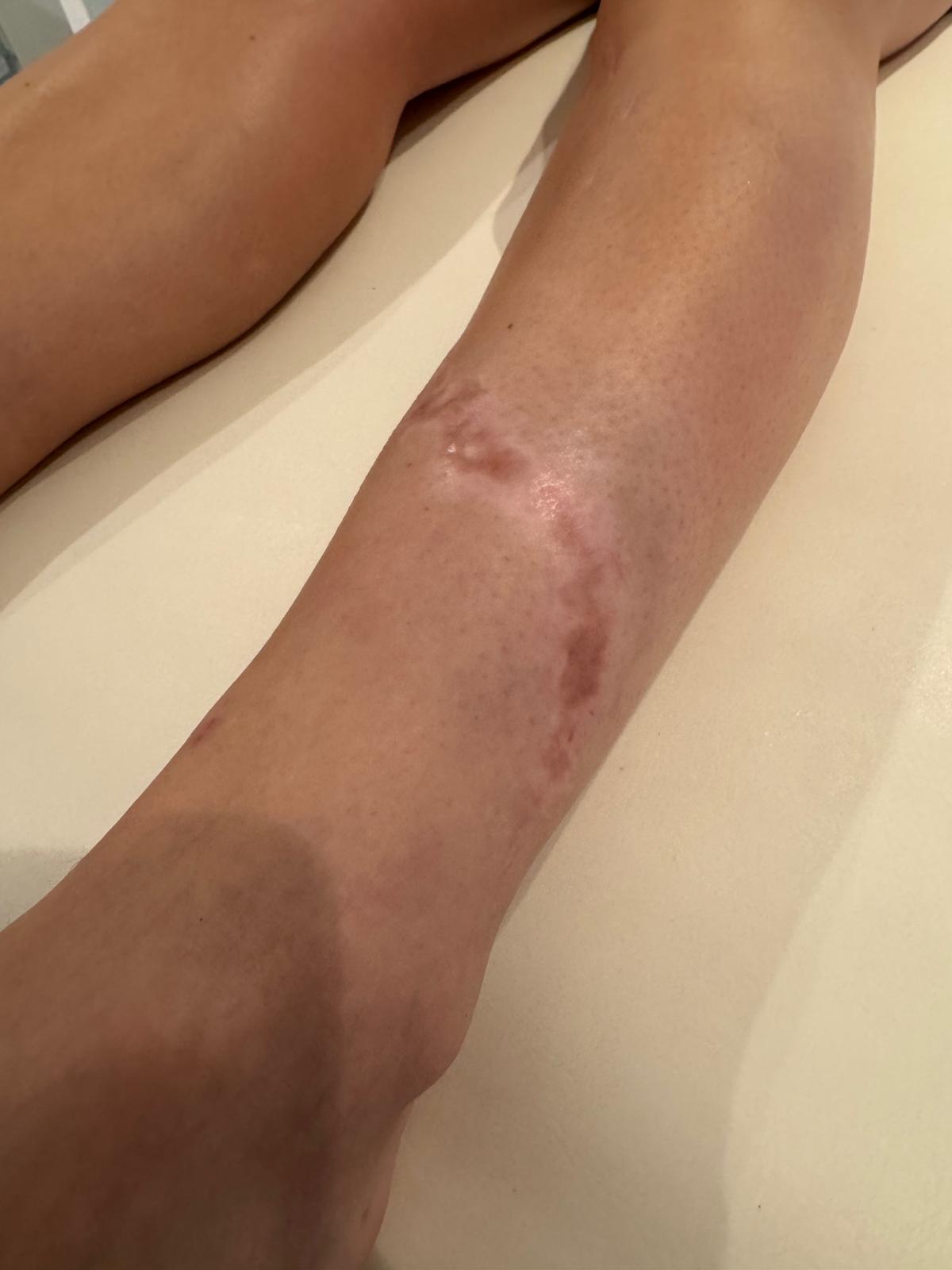 Healed scar on the lower leg months after surgery