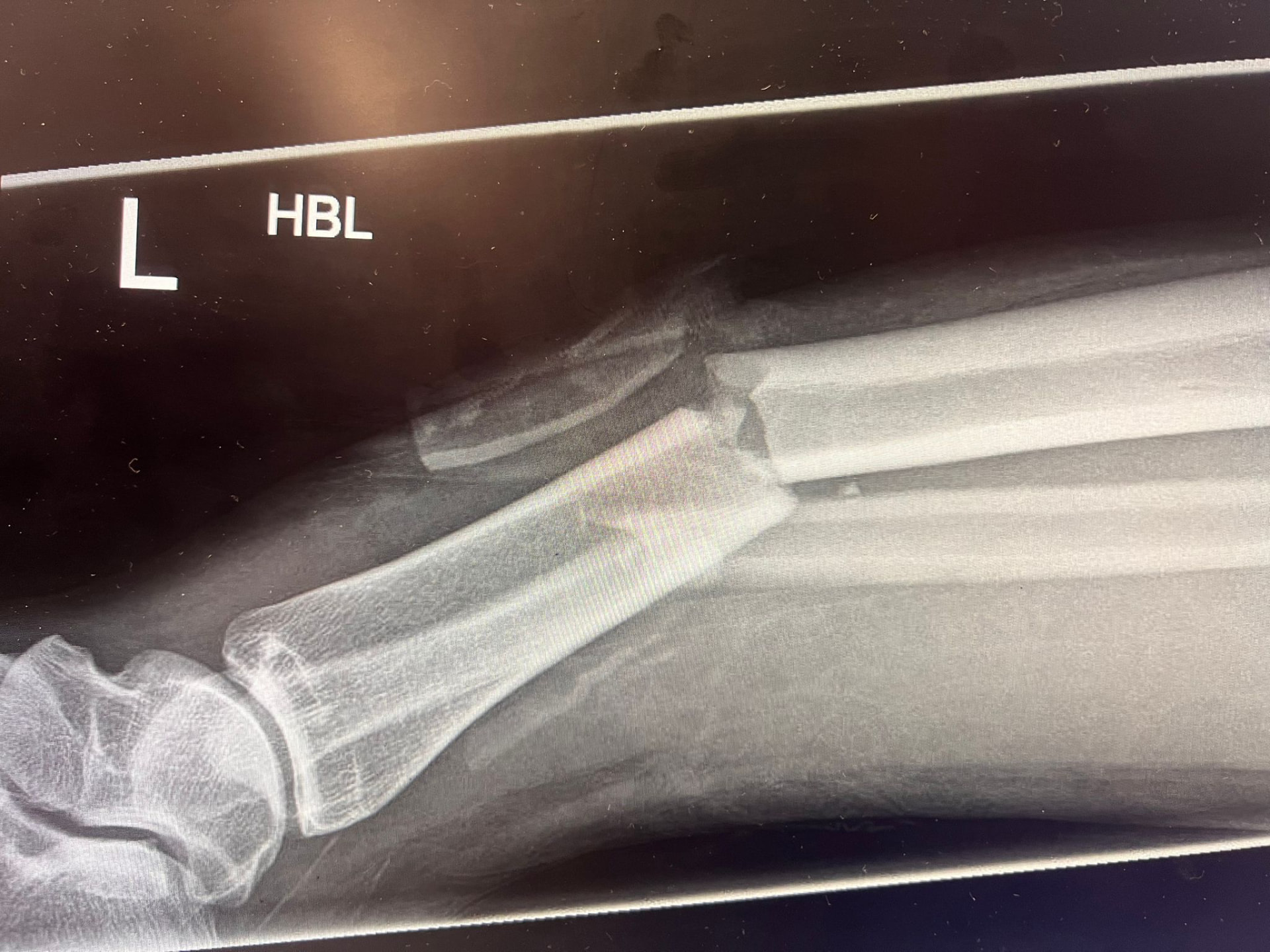 X-ray showing displaced fracture of the left tibia and fibula