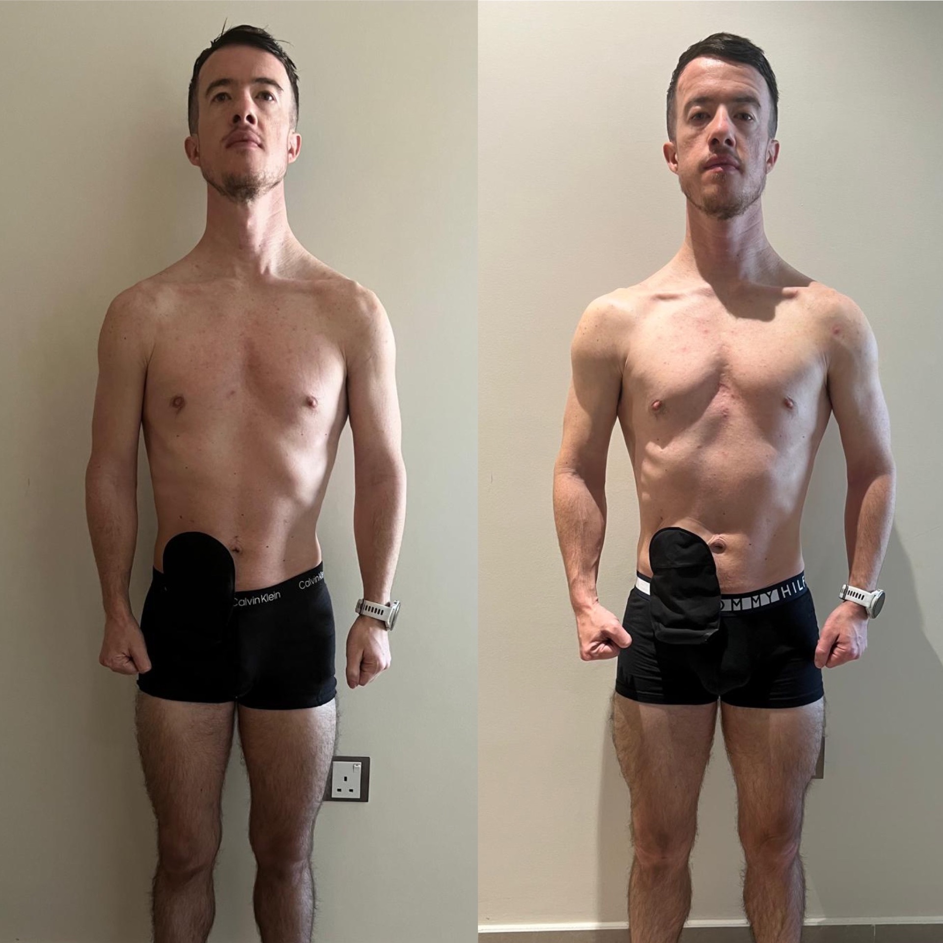 Before and after transformation — 6 months - post stoma surgery due to Ulcerative Colitis